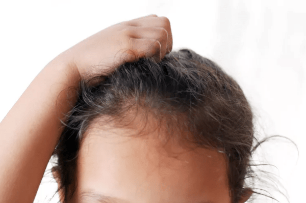 Pour une Rentrée sans Poux : La Solution Naturelle à Essayer !